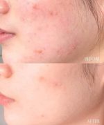 SOME BY MI AHA BHA PHA 30 DAYS MIRACLE ACNE CLEAR FOAM 100ML - Image 3