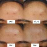 SOME BY MI AHA BHA PHA 14 DAYS SUPER MIRACLE SPOT ALL KILL CREAM 30ML - Image 3