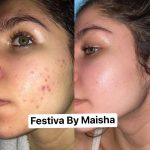 DIFFERIN GEL ACNE TREATMENT 15G - Image 4