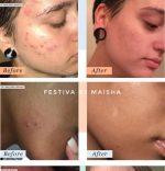 PANOXYL ACNE FOAMING WASH BENZOYL PEROXIDE 10% -156 G - Image 3